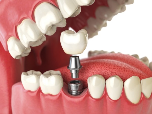 Couronnes dentaire à Bordeaux : implants dentaires